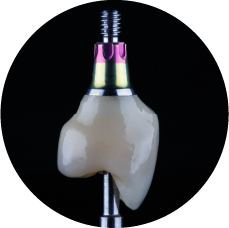 Protesis sobre implantes dentales Protesis sobre implantes dentales